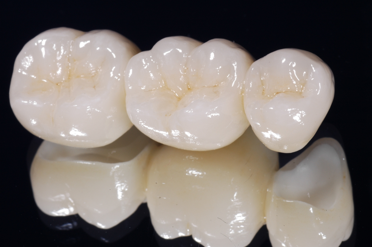 Зубные керамические протезы