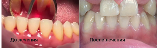 лечение кисты зубов до и после