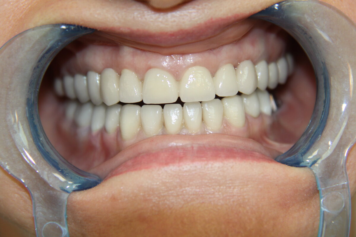 Зубные металлокерамические протезы