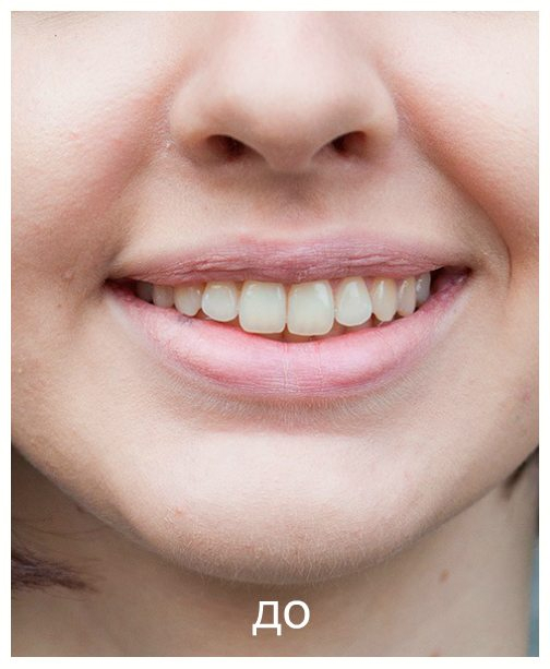 фото до отбеливания зубов