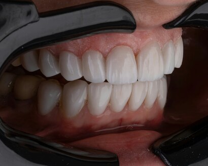 Фторирование зубов. Зачем нужна эта процедура?