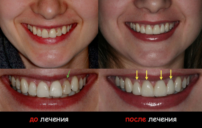 до и после лечения зубов