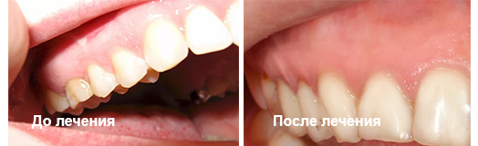 лечение кисты зубов