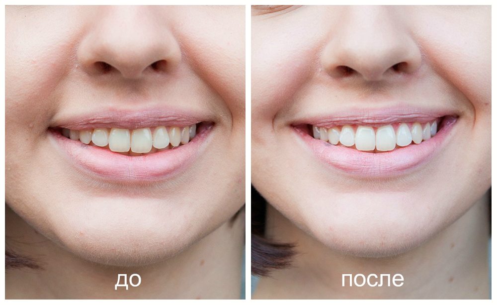 Отбеливание зубов Zoom до и после