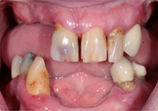 Вид до имплантации зубов