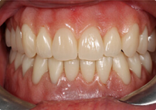 Вид после имплантации зубов
