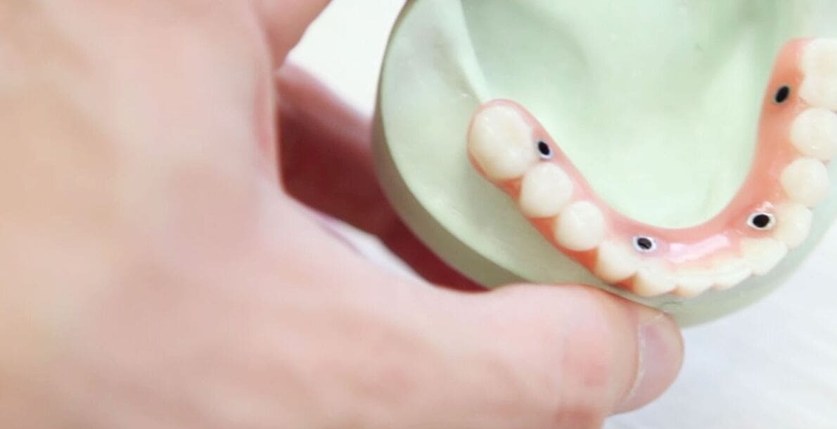 Имплантация зубов верхней челюсти