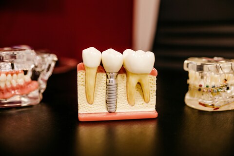 Преимущества титановых зубных имплантов
